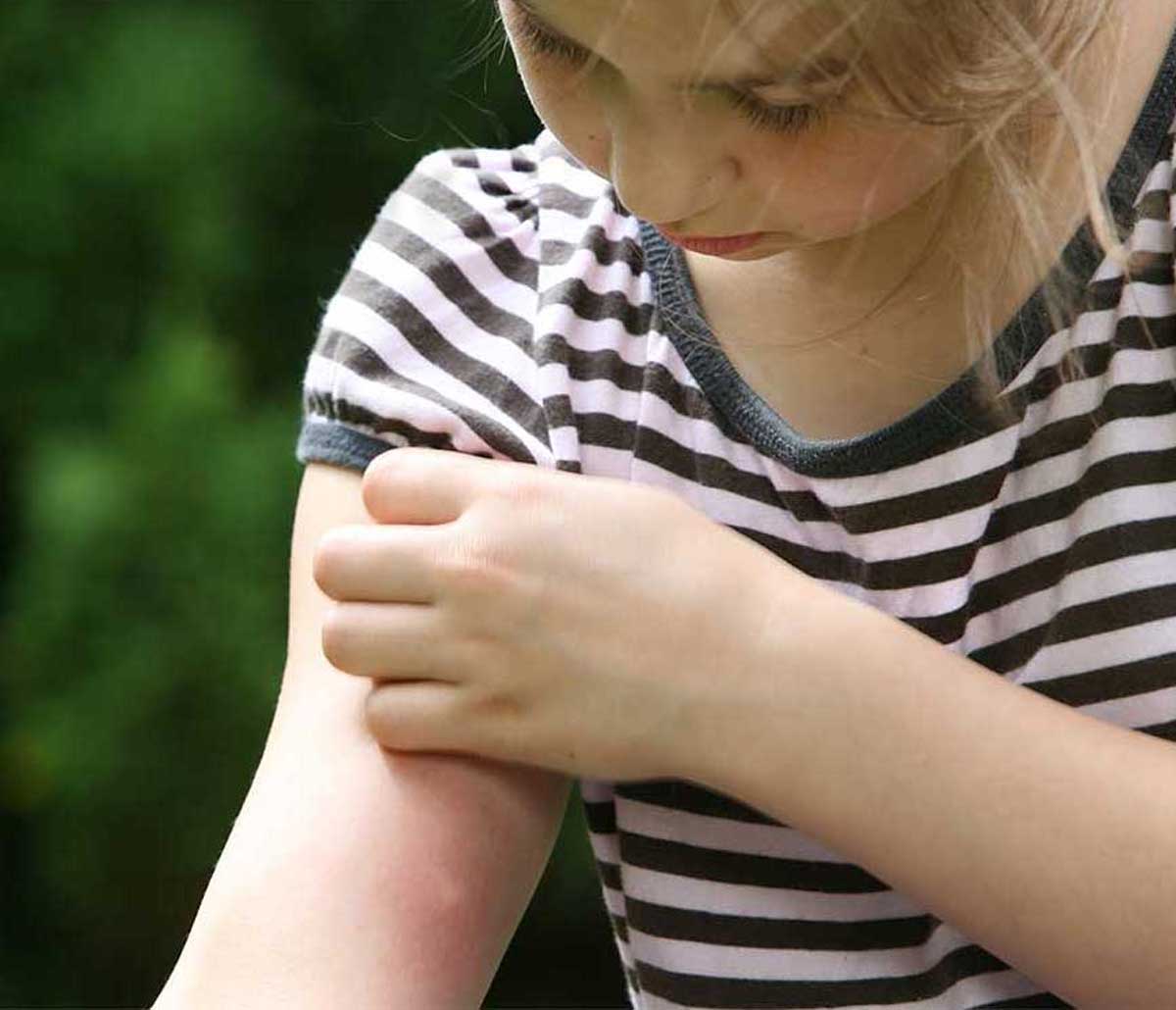 A young girl scratching a bug bite on her arm